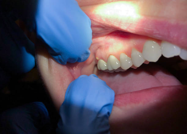 Best Emergency Dental Care for Sports Injuries in Otsego, MN